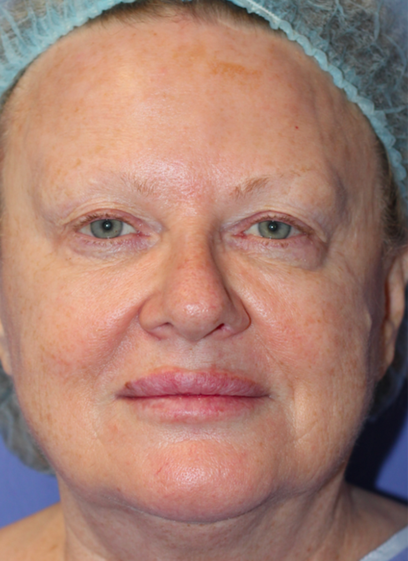 Skin Transformation Before and After | PERK Plastic Surgery