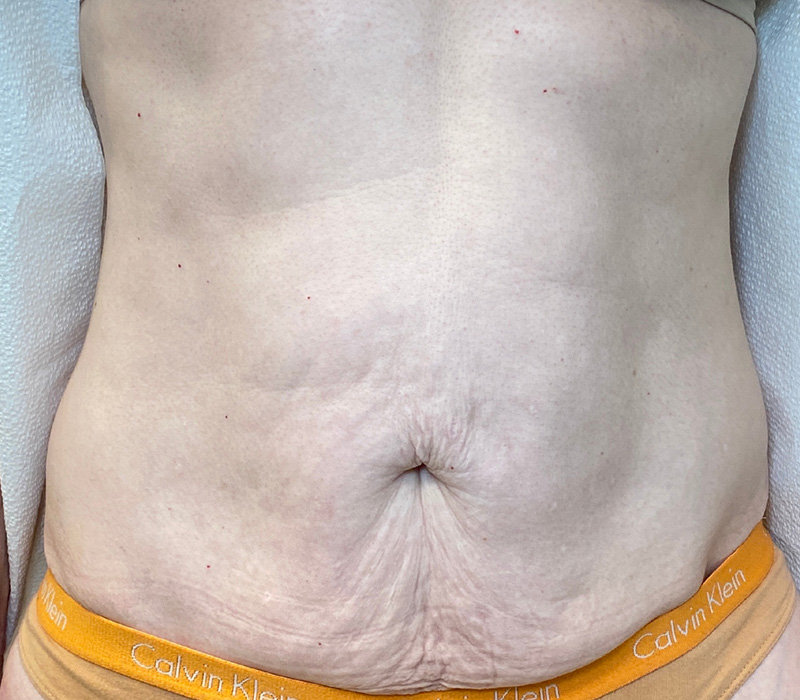 Sofwave Before and After | PERK Plastic Surgery