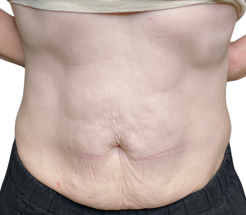 Sofwave Before and After | PERK Plastic Surgery