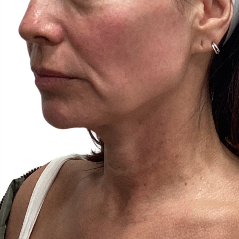 Sofwave Before and After | PERK Plastic Surgery