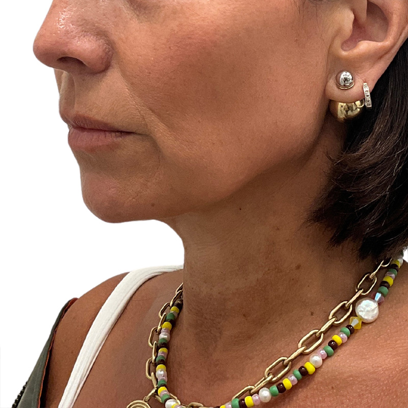 Sofwave Before and After | PERK Plastic Surgery