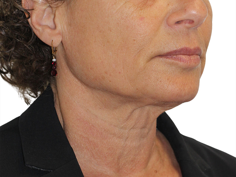 Sofwave Before and After | PERK Plastic Surgery
