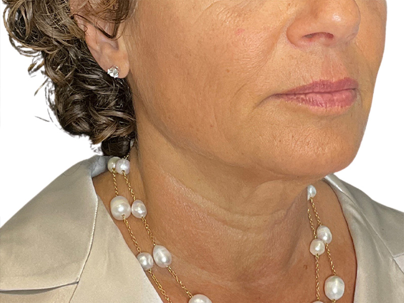 Sofwave Before and After | PERK Plastic Surgery