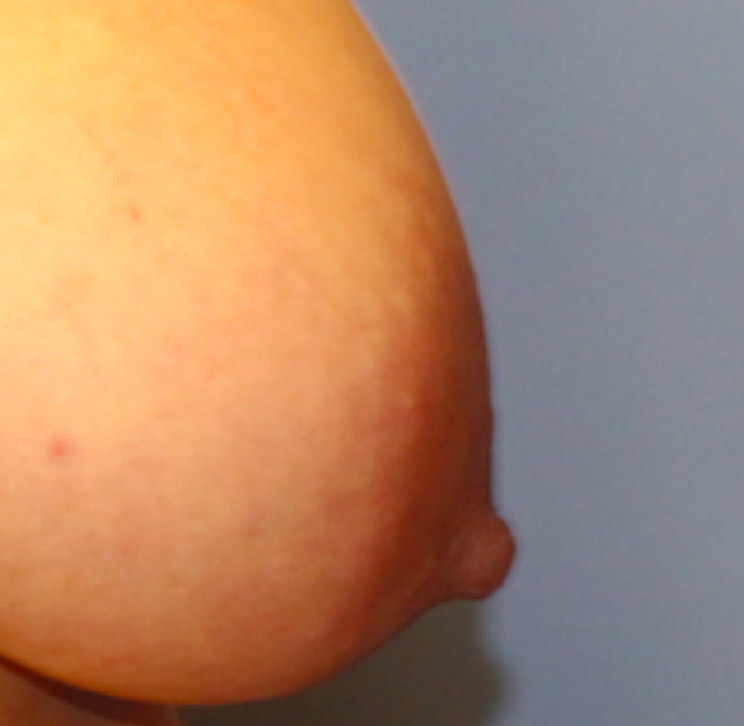 areola reduction surgery before