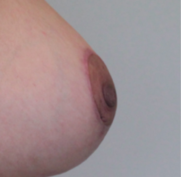 areola reduction surgery after