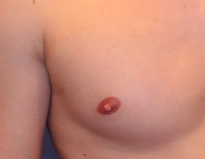 nipple reduction surgery before