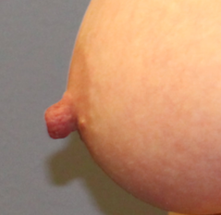 nipple reduction surgery before