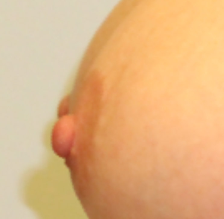 nipple reduction surgery after