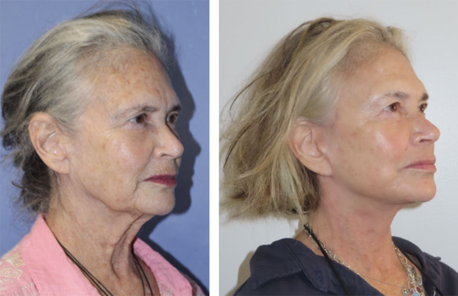 Deep Plane Facelift patient