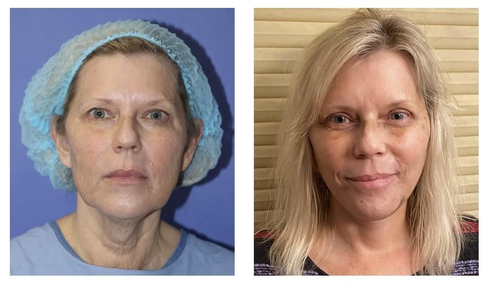 before and 1.5 weeks after Beverly Hills facelift