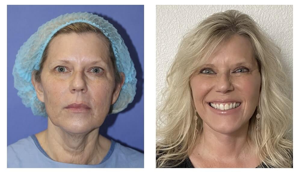 before and 3 weeks after Beverly Hills facelift