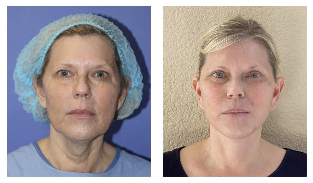 before and 1 month after Beverly Hills facelift - 01