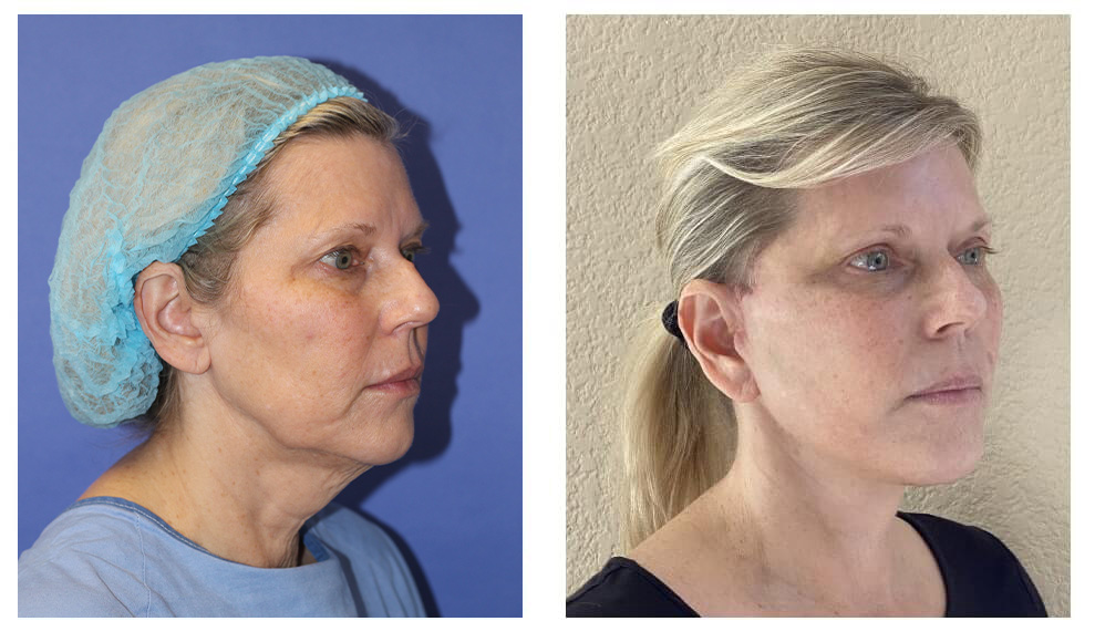 before and 1 month after Beverly Hills facelift - 02
