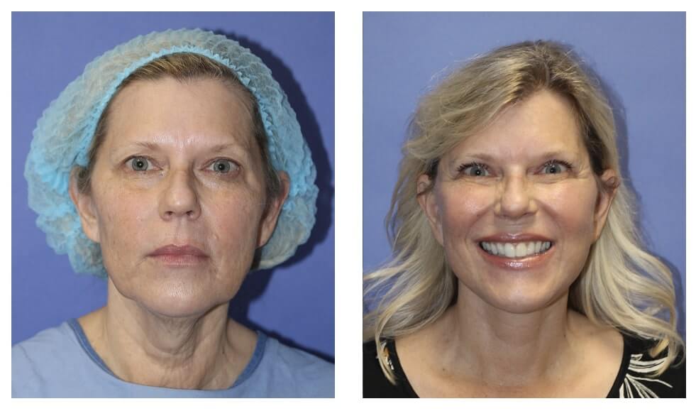before and 3 months after Beverly Hills facelift