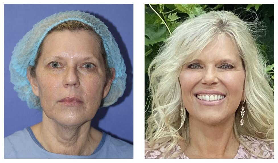 before and 4 months after Beverly Hills facelift