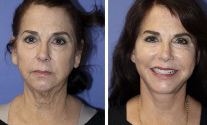 Fat Grafting to Face Beverly Hills Facial Fat Transfer in Beverly Hills