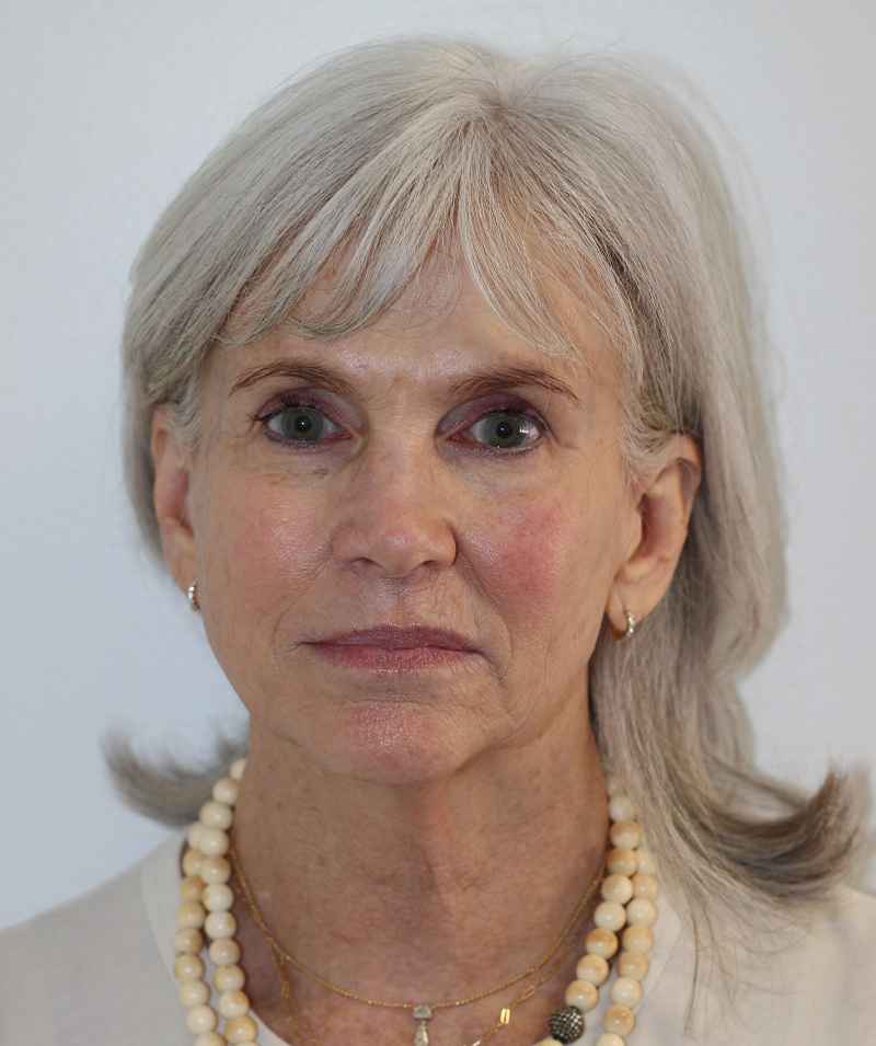 Facial Rejuvenation Beverly Hills