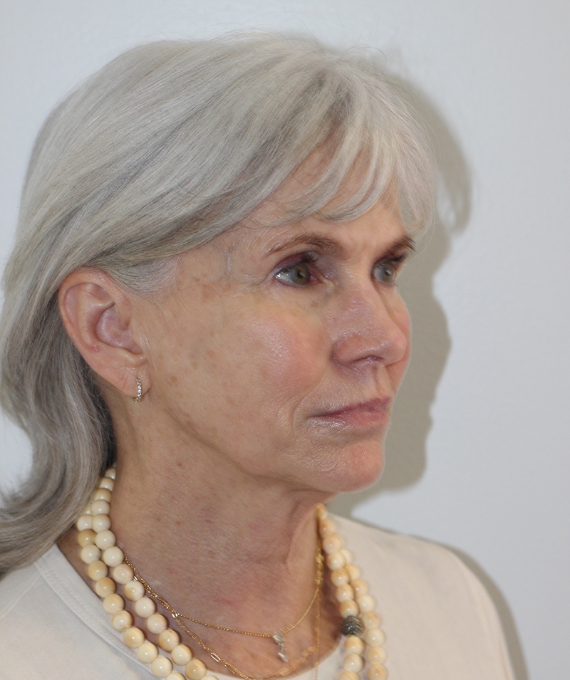 Facial Rejuvenation Beverly Hills