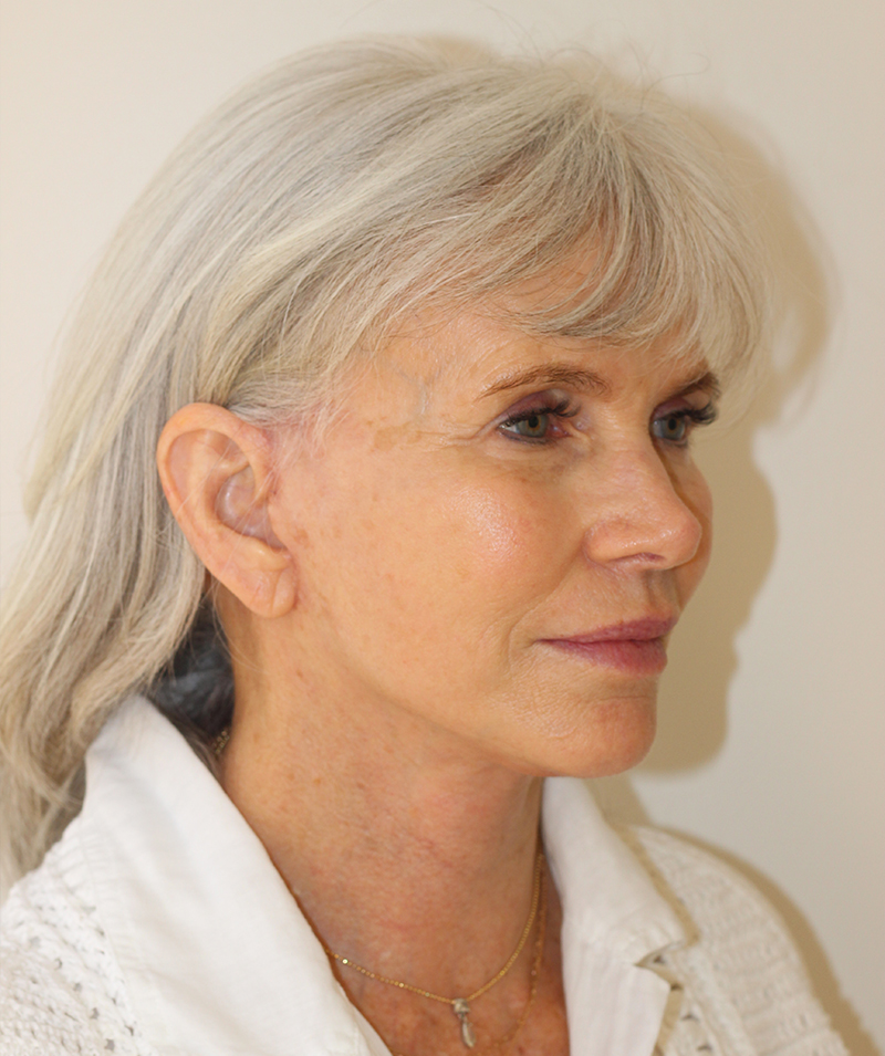 Facial Rejuvenation Beverly Hills