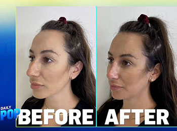 Dr. Lee performs liquid rhinoplasty video