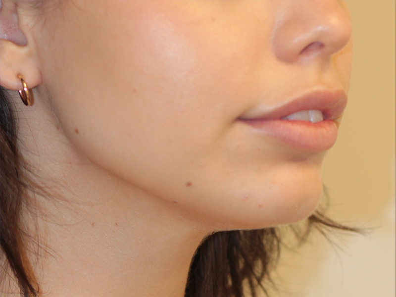 Dermal Fillers Beverly Hills