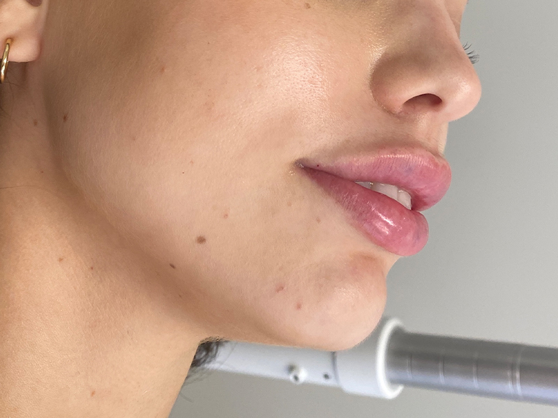 Dermal Fillers Beverly Hills