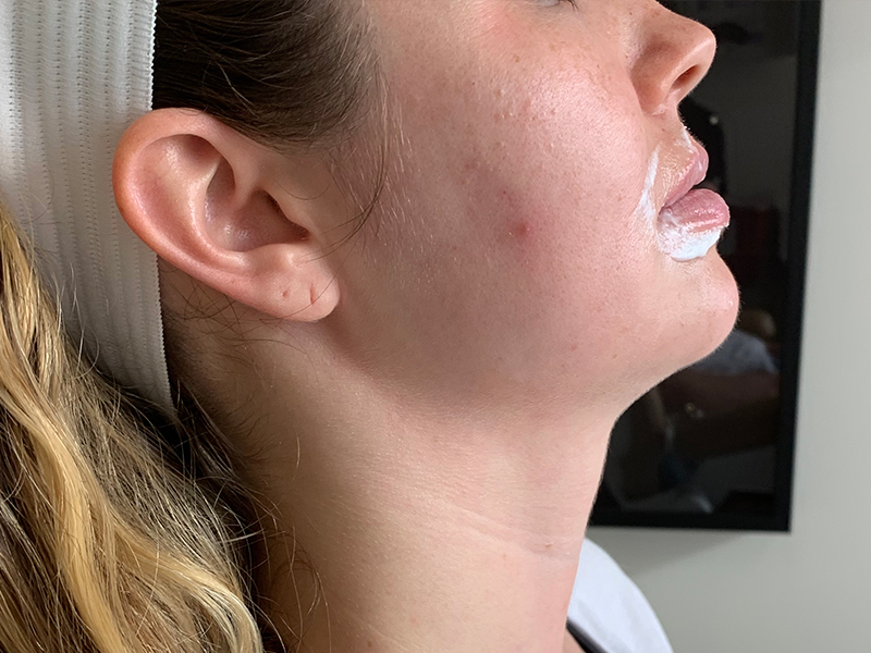 Dermal Fillers Beverly Hills