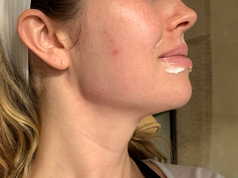 Dermal Fillers Beverly Hills