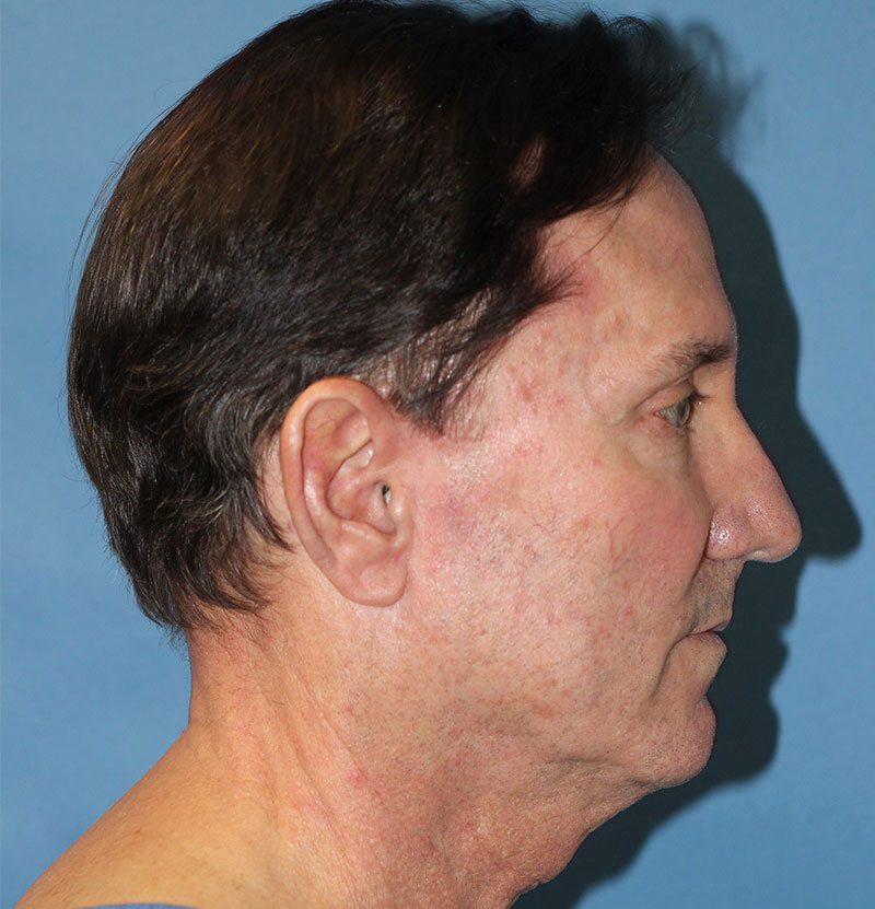 Plastic Surgery for Men | PERK Plastic Surgery